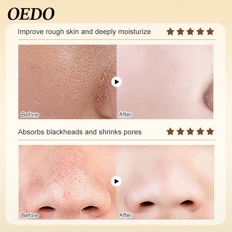 Blackhead Removing Mask