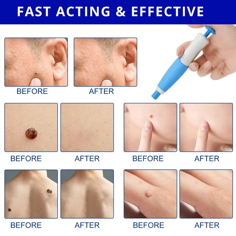 Skin Tag Remover Kit