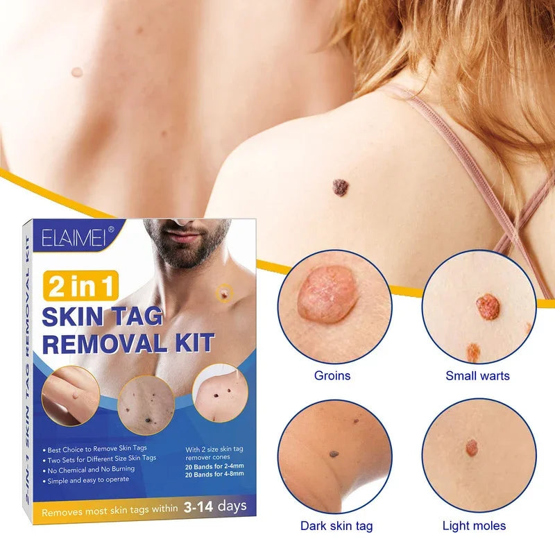 Skin Tag Remover Kit