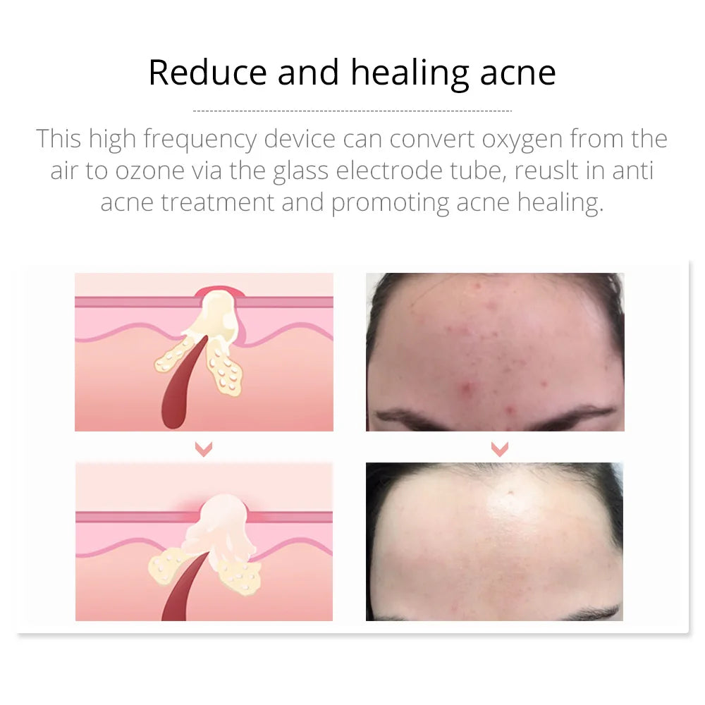 High Frequency Facial Therapy Wand