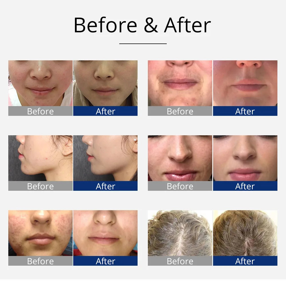 High Frequency Facial Therapy Wand