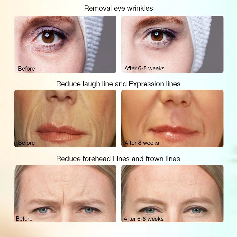 Radio Frequency Facial Massager